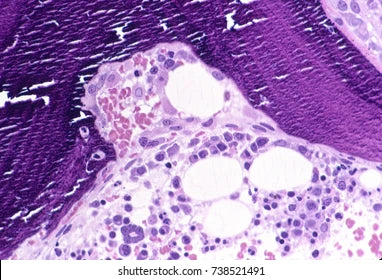 Tout savoir sur l'ostéolyse