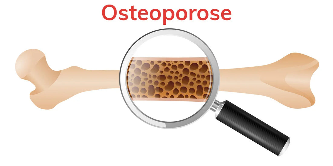 tout savoir sur l'ostéoporose